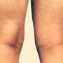 Bakers Cyst Knee 1 Baker’s Cyst Knee