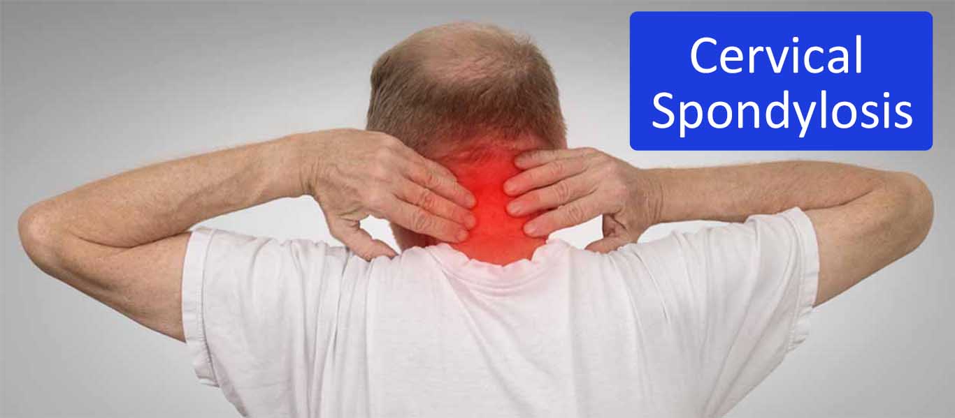 Cervical Spondylosis Cervical Spondylosis