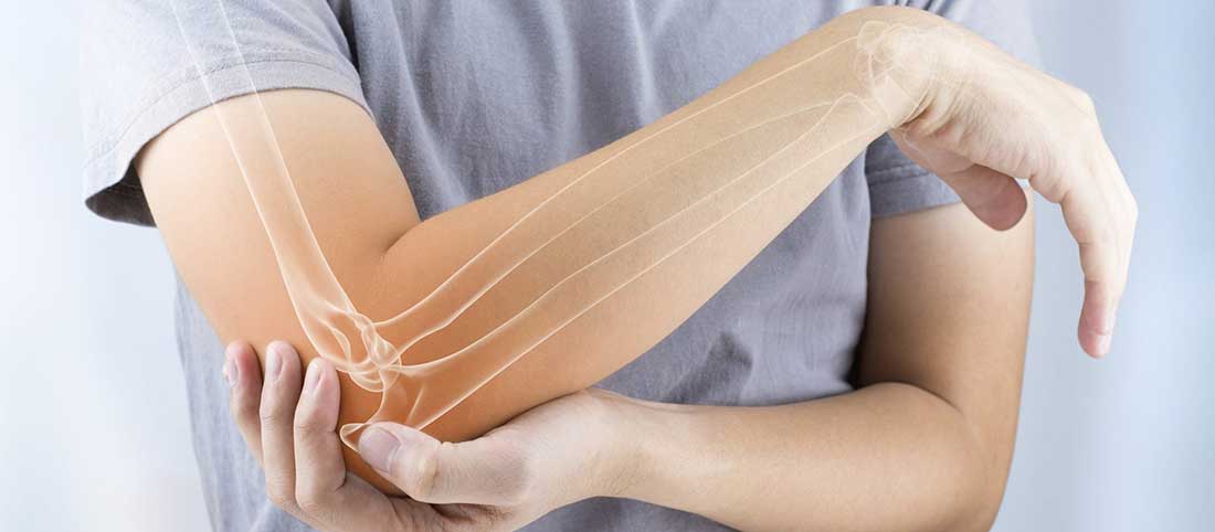 Cubital Tunnel Syndrome Cubital Tunnel Syndrome