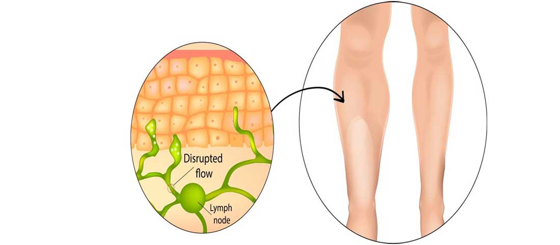 Lymphedema Lymphedema: Have a little Knowledge about it