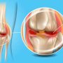 Meniscus Tear Meniscus Tear