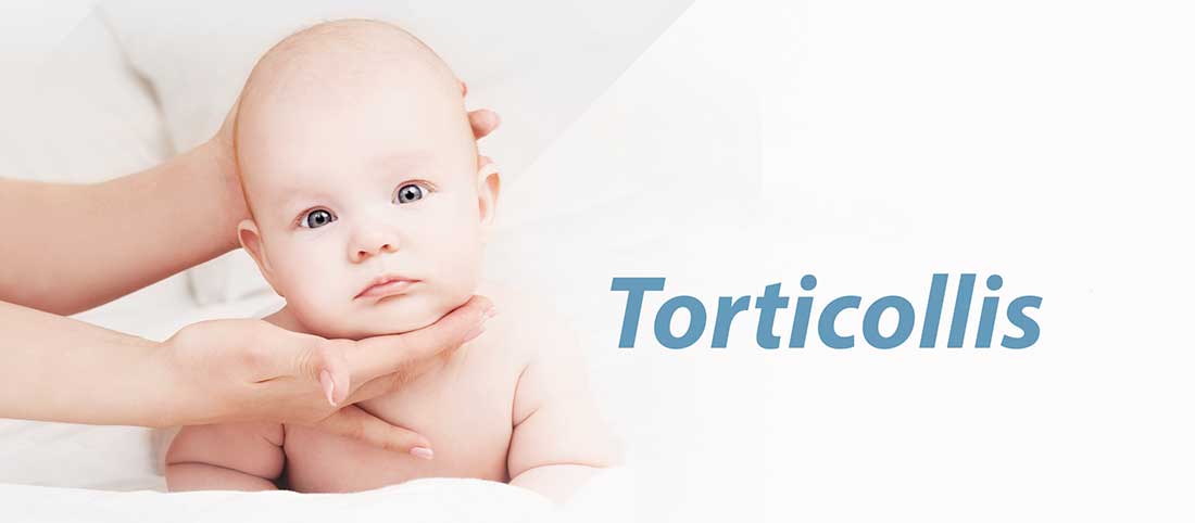Torticollis Torticollis (Wry neck)