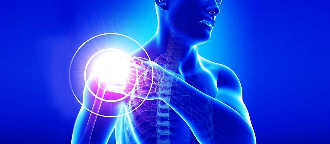 bicespstendinopath mayfairy Biceps tendinopathy: What you need to know