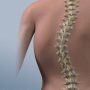 scoliosis Scoliosis- Causes, Symptoms & Treatment