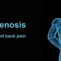 spbg Spinal stenosis: a leading cause of back pain