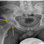 Hip Septic Arthritis of Hip